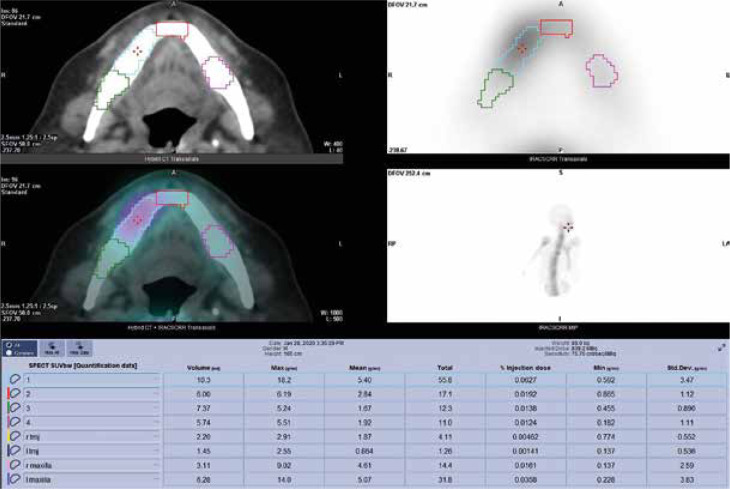 Volumetric analysis of mandibular lesions with SPECT/CT: a pilot clinical study of maximum standardized uptake value.