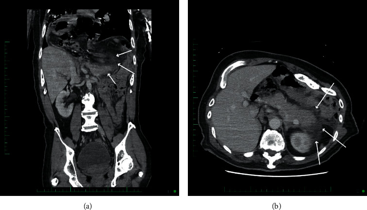 Missed at Birth: A Rare Case of Acute Pancreatitis Secondary to Congenital Diaphragmatic Hernia.