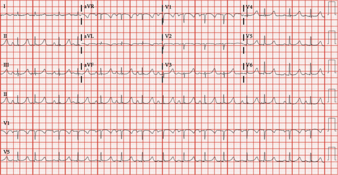 Reverse Takutsubo Cardiomyopathy in a Patient with Phlegmasia Cerulea Dolens.
