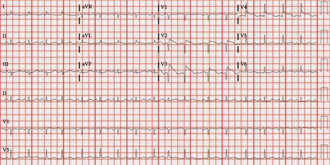 Reverse Takutsubo Cardiomyopathy in a Patient with Phlegmasia Cerulea Dolens.