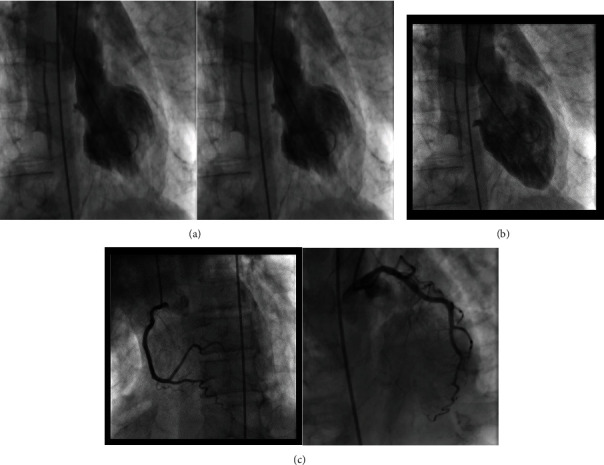 Reverse Takutsubo Cardiomyopathy in a Patient with Phlegmasia Cerulea Dolens.