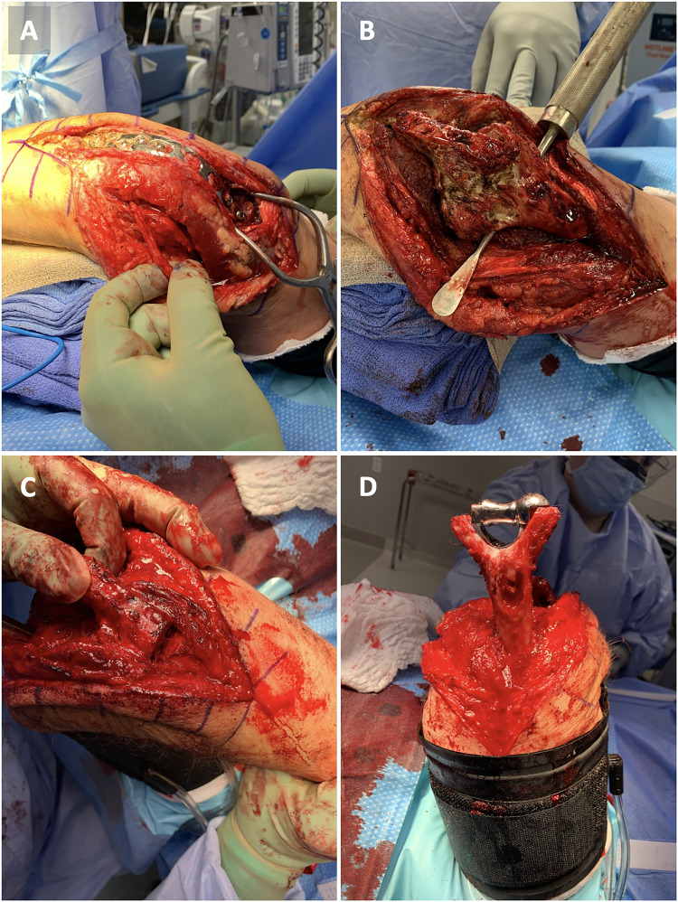 Conversion of Elbow Arthrodesis to Total Elbow Arthroplasty: A Case Report and Literature Review.