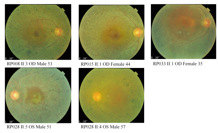 Whole-exome sequencing identified genes known to be responsible for retinitis pigmentosa in 28 Chinese families.