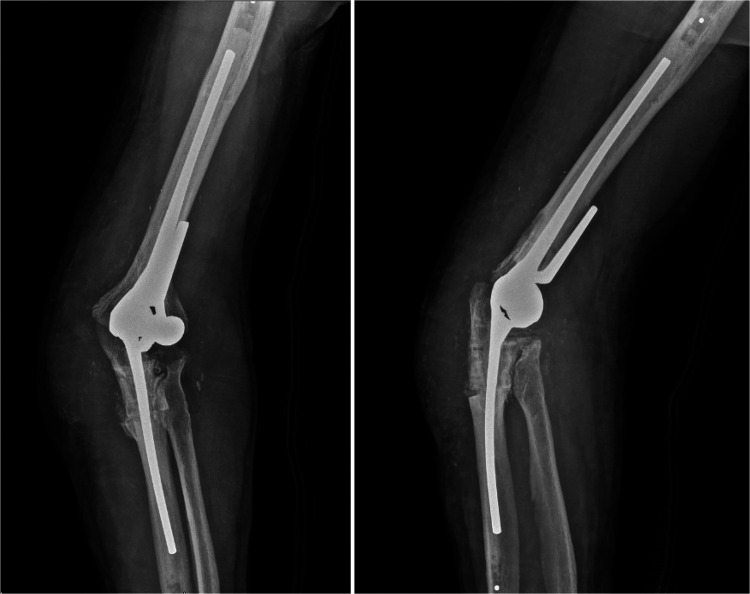 Conversion of Elbow Arthrodesis to Total Elbow Arthroplasty: A Case Report and Literature Review.