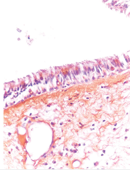 Olfactory Neuroepithelium in Olfactory Cleft Polyps: Do They Have Any Effect on Olfaction Results After Endoscopic Sinus Surgery?