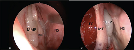 Olfactory Neuroepithelium in Olfactory Cleft Polyps: Do They Have Any Effect on Olfaction Results After Endoscopic Sinus Surgery?