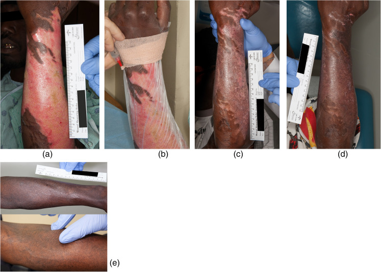 The effect of mesenchymal stem cells improves the healing of burn wounds: a phase 1 dose-escalation clinical trial.