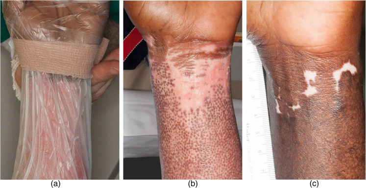 The effect of mesenchymal stem cells improves the healing of burn wounds: a phase 1 dose-escalation clinical trial.