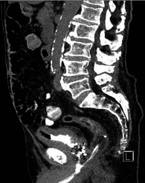 A Case of Traumatic Catheterisation leading to Rectal Perforation and Periprostatic Abscess.