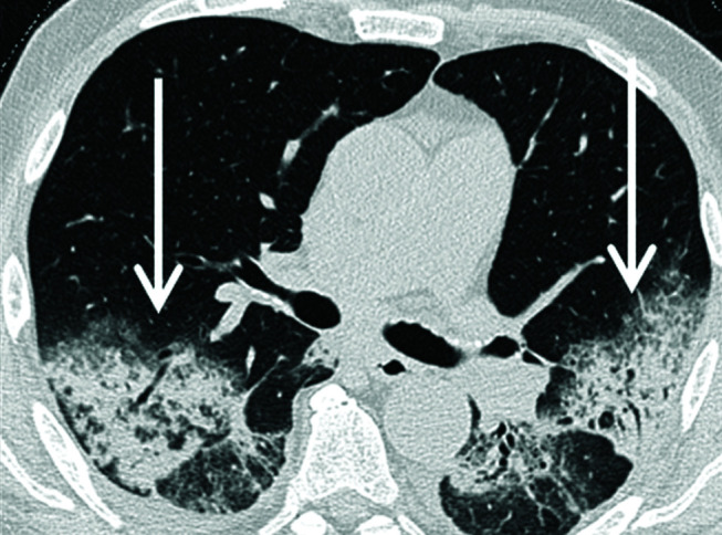 The many faces of cryptogenic organizing pneumonia (COP).