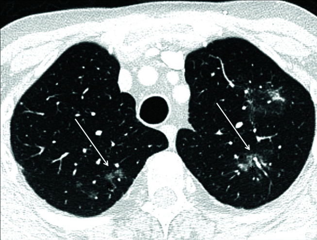 The many faces of cryptogenic organizing pneumonia (COP).