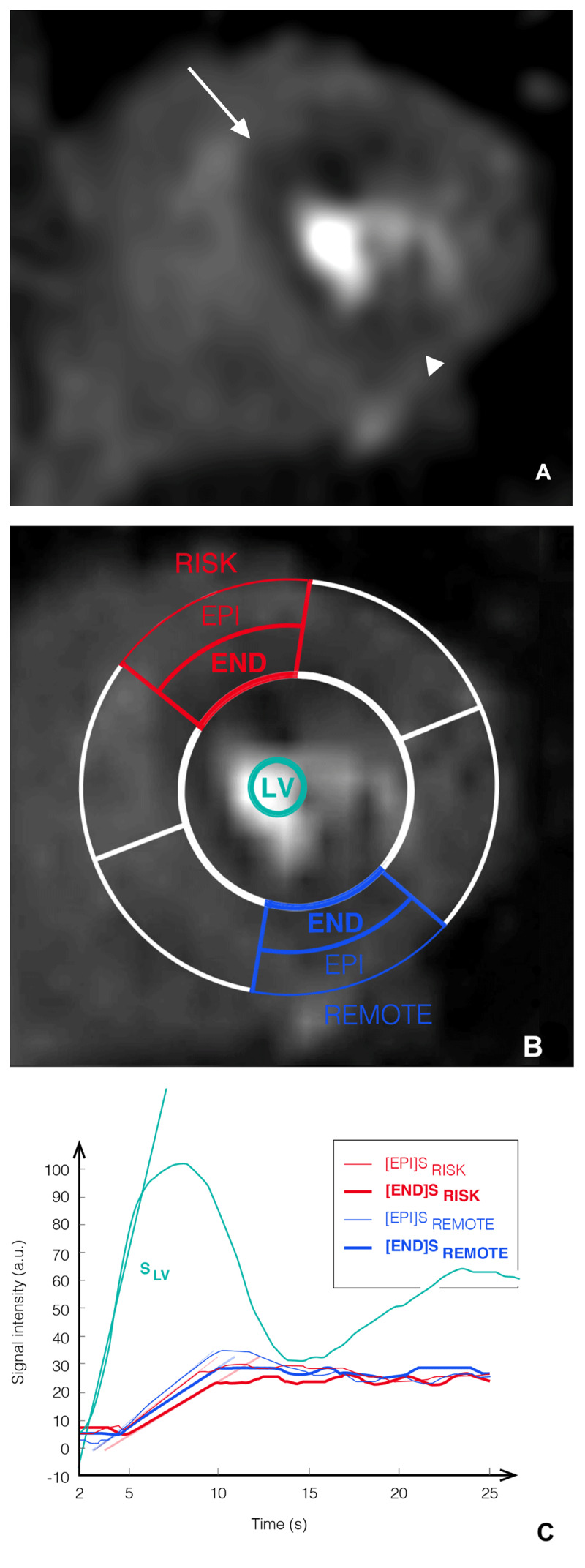 Semi-Quantitative Versus Visual Analysis of Adenosine Perfusion Magnetic Resonance Imaging in Intermediate-Grade Coronary Artery Stenosis Using Fractional Flow Reserve as the Reference: A Pilot Study.