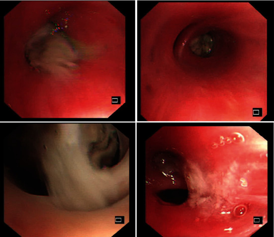 Allergic Bronchopulmonary Aspergillosis with an Atypical Mass-Like Presentation.