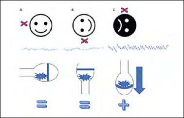 The clinical significance of direction-fixed mono-positional apogeotropic horizontal nystagmus.