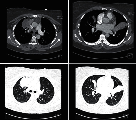 Allergic Bronchopulmonary Aspergillosis with an Atypical Mass-Like Presentation.