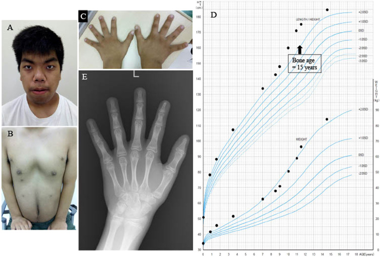 Precocious puberty in a case of Simpson-Golabi-Behmel syndrome with a de novo 240-kb deletion including GPC3.