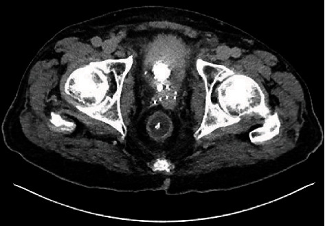 A Case of Traumatic Catheterisation leading to Rectal Perforation and Periprostatic Abscess.