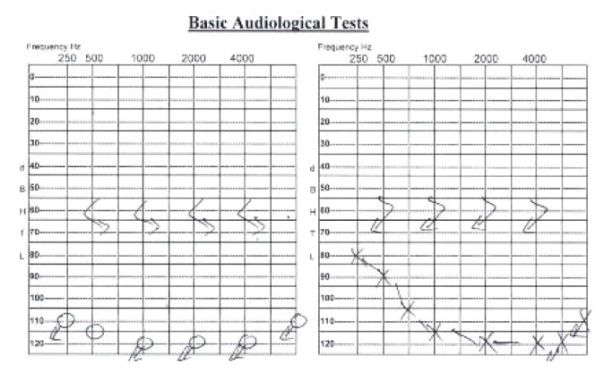 Epilepsy and Hearing Loss in a Patient with a Rare Heterozygous Variant in the <i>CACNA1H</i> Gene.