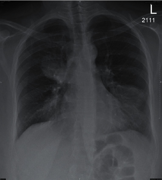 Allergic Bronchopulmonary Aspergillosis with an Atypical Mass-Like Presentation.