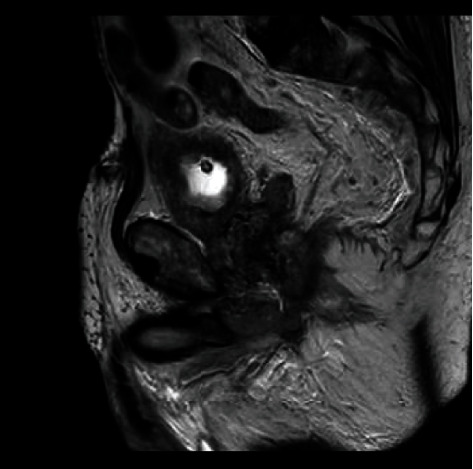 A Case of Traumatic Catheterisation leading to Rectal Perforation and Periprostatic Abscess.