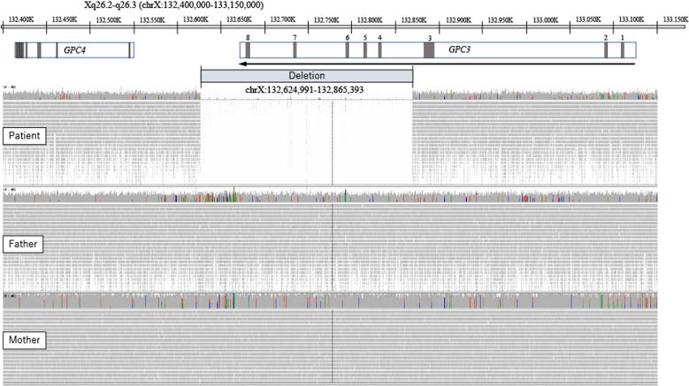 Precocious puberty in a case of Simpson-Golabi-Behmel syndrome with a de novo 240-kb deletion including GPC3.