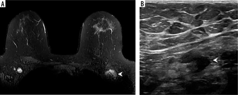 Lymphadenopathy in the era of COVID-19 vaccination - an oncological dilemma in diagnostic imaging.