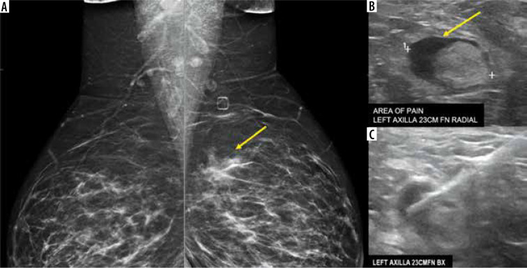 Lymphadenopathy in the era of COVID-19 vaccination - an oncological dilemma in diagnostic imaging.