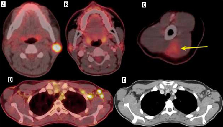 Lymphadenopathy in the era of COVID-19 vaccination - an oncological dilemma in diagnostic imaging.