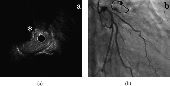 Heart Team Intervention for Calcified Left Main Coronary Disease and Jeopardized Left Internal Mammary Artery Graft.