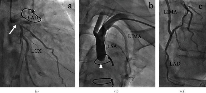 Heart Team Intervention for Calcified Left Main Coronary Disease and Jeopardized Left Internal Mammary Artery Graft.