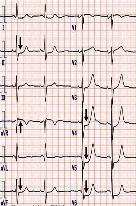 Heart Team Intervention for Calcified Left Main Coronary Disease and Jeopardized Left Internal Mammary Artery Graft.
