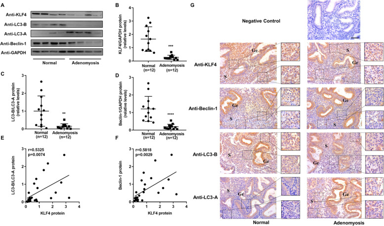 Decreased Krüppel-like factor 4 in adenomyosis impairs decidualization by repressing autophagy in human endometrial stromal cells.