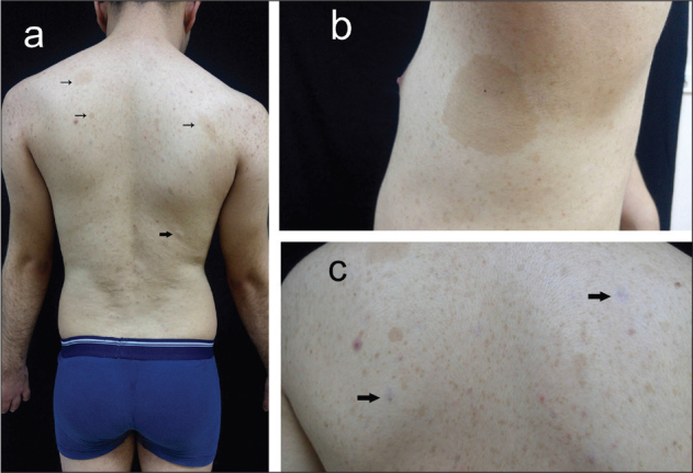 Case Report for Two Siblings Carrying Neurofibromatosis Type 1 with a Rare <i>NF1</i>: c.5392C>T Mutation.