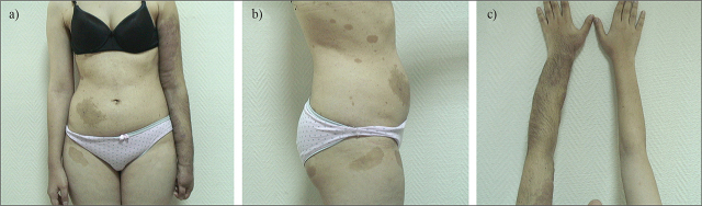 Case Report for Two Siblings Carrying Neurofibromatosis Type 1 with a Rare <i>NF1</i>: c.5392C>T Mutation.