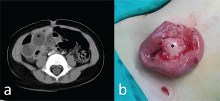 Gastrointestinal Tract Duplications in Children: A Tertiary Referral Center Experience.