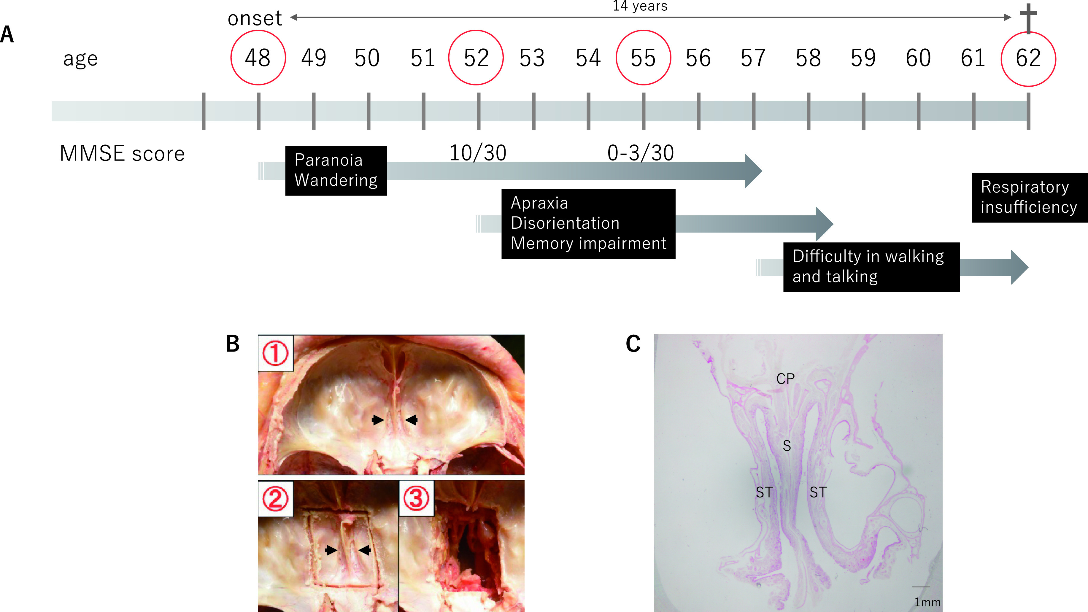 A Histochemical Analysis of Neurofibrillary Tangles in Olfactory Epithelium, a Study Based on an Autopsy Case of Juvenile Alzheimer's Disease.