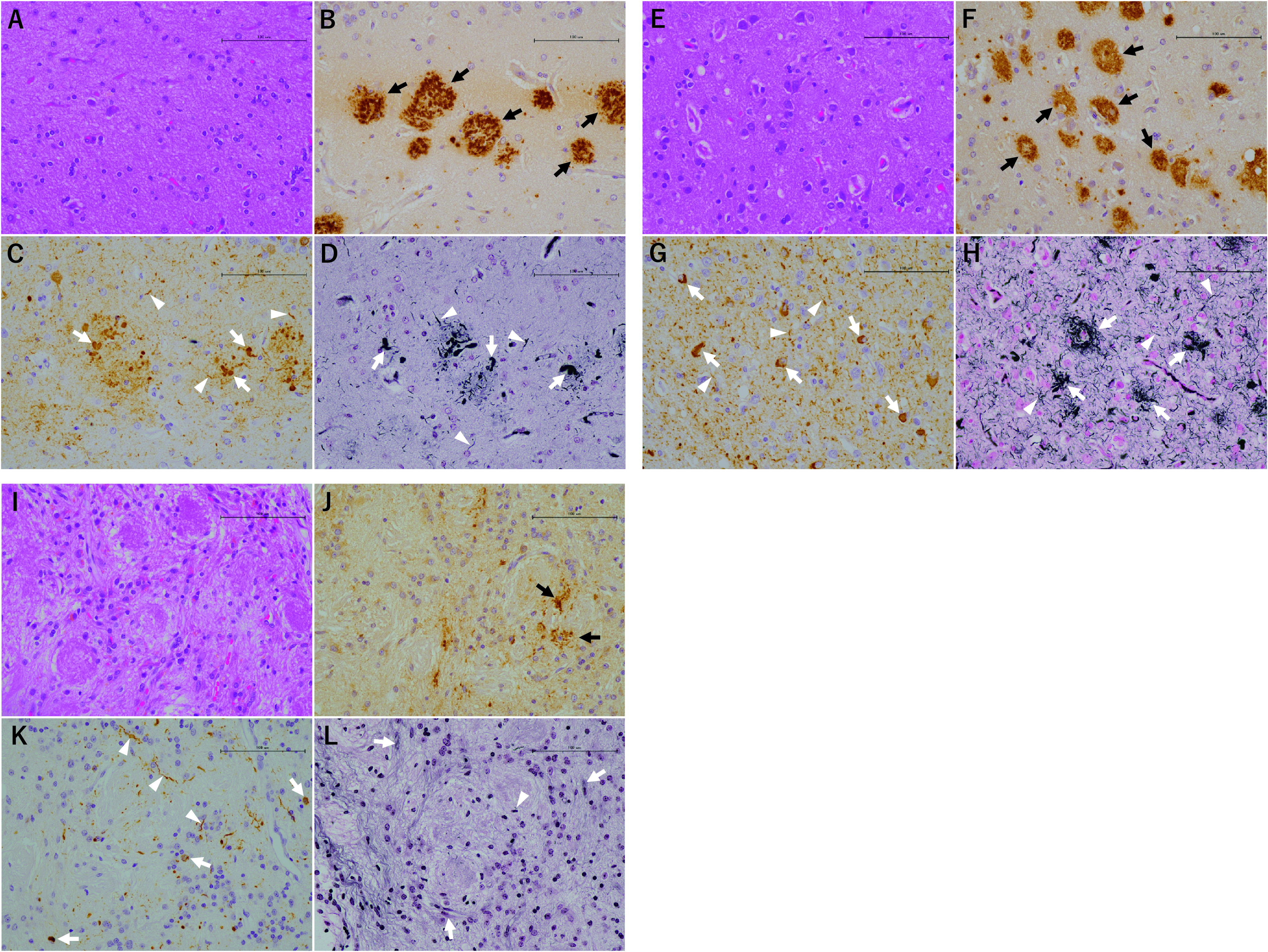 A Histochemical Analysis of Neurofibrillary Tangles in Olfactory Epithelium, a Study Based on an Autopsy Case of Juvenile Alzheimer's Disease.