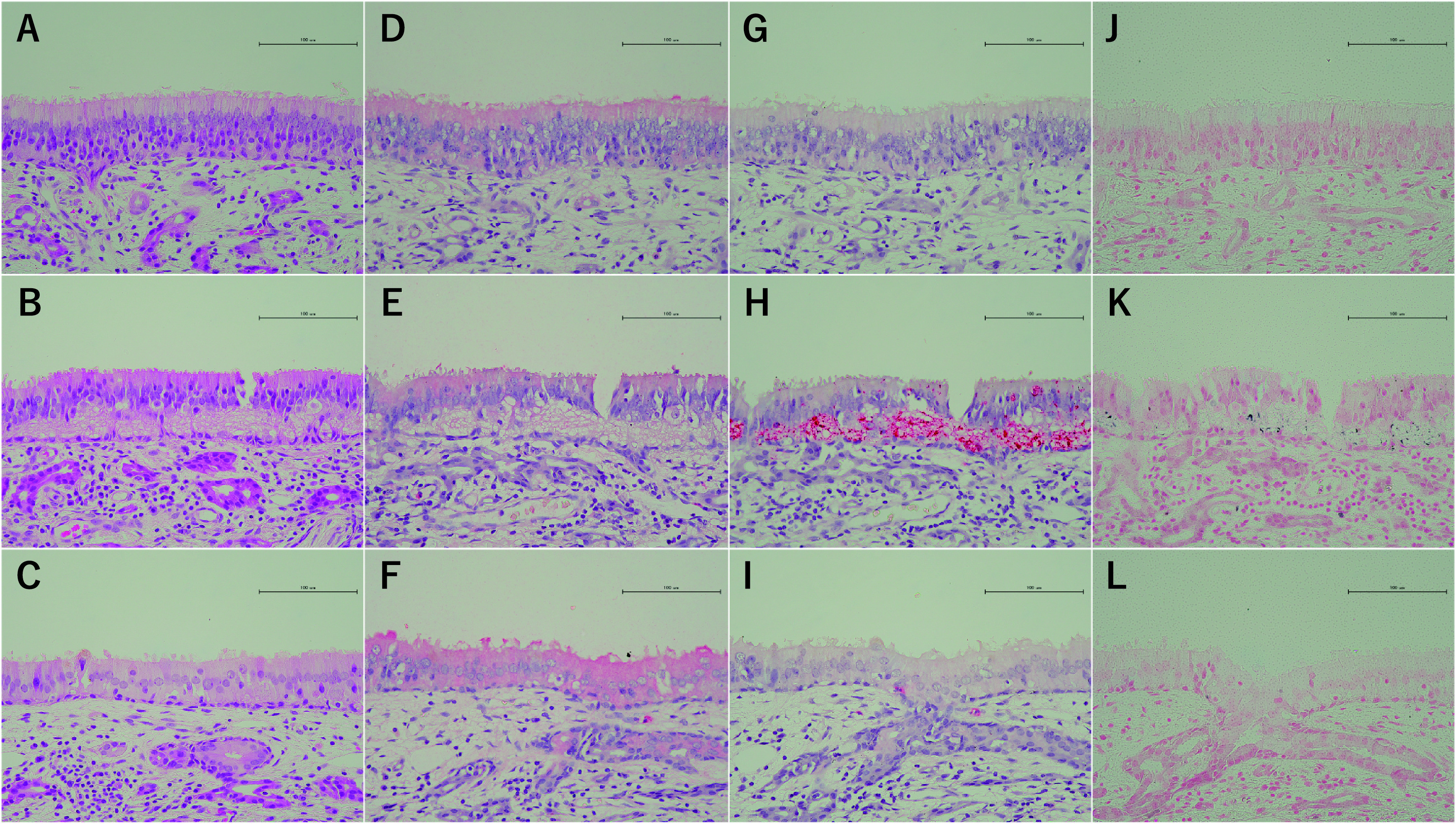 A Histochemical Analysis of Neurofibrillary Tangles in Olfactory Epithelium, a Study Based on an Autopsy Case of Juvenile Alzheimer's Disease.