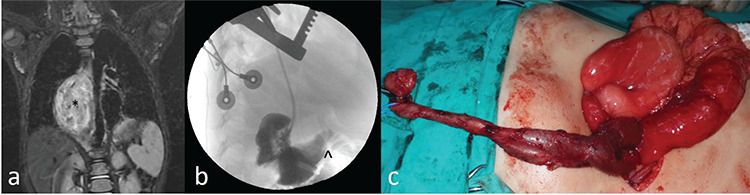 Gastrointestinal Tract Duplications in Children: A Tertiary Referral Center Experience.