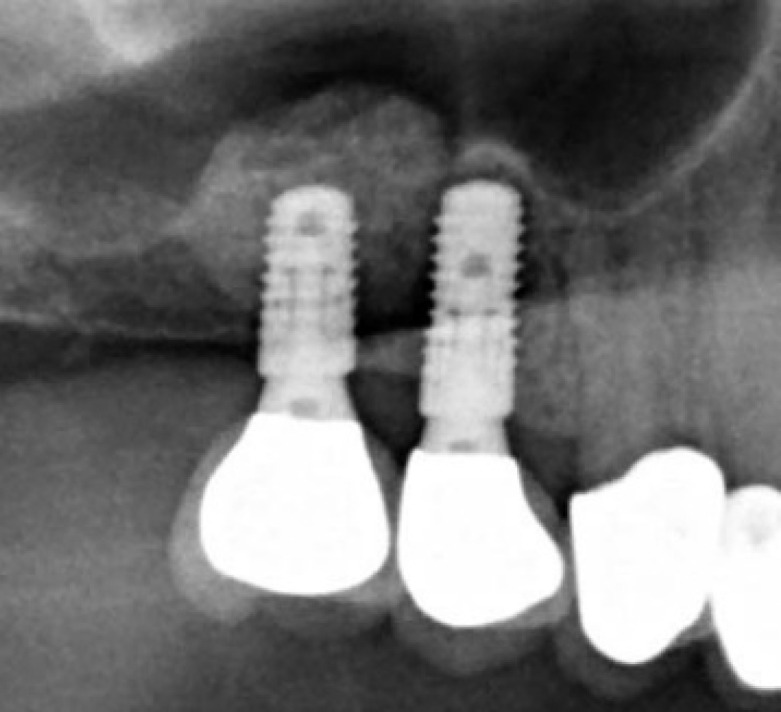 Short versus Standard Length Implants with Sinus Floor Elevation for the Atrophic Posterior Maxilla.