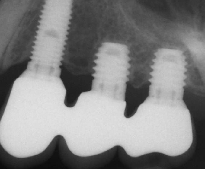 Short versus Standard Length Implants with Sinus Floor Elevation for the Atrophic Posterior Maxilla.