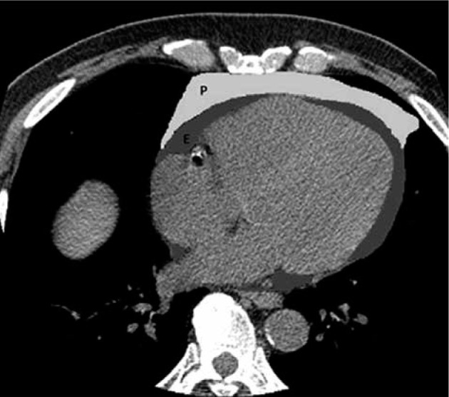 Can epicardial and pericardial adipose tissue volume predict the presence and severity of coronary artery disease?