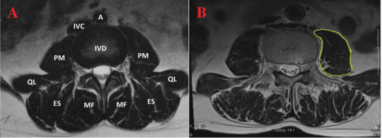 The relationship between radiological paraspinal lumbar measures and clinical measures of sarcopenia in older patients with chronic lower back pain.