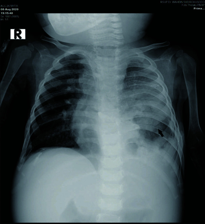 Multiple organ tuberculomas in infant.