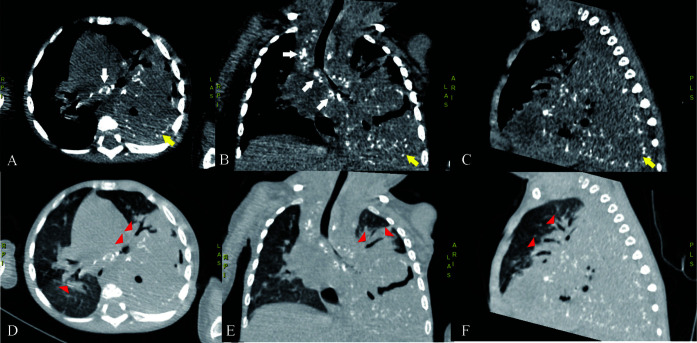 Multiple organ tuberculomas in infant.