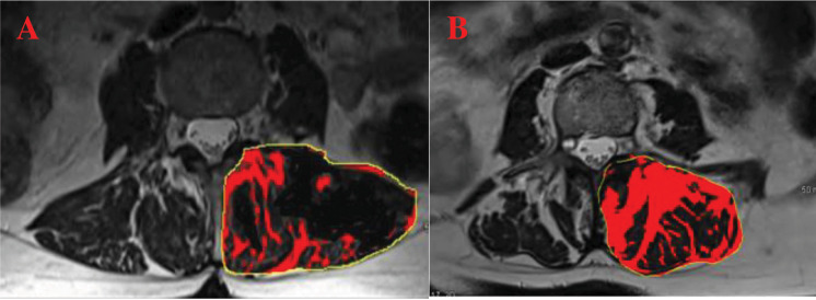 The relationship between radiological paraspinal lumbar measures and clinical measures of sarcopenia in older patients with chronic lower back pain.