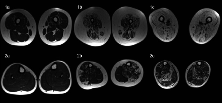 Muscle quantitative MRI in adult SMA patients on nusinersen treatment: a longitudinal study.