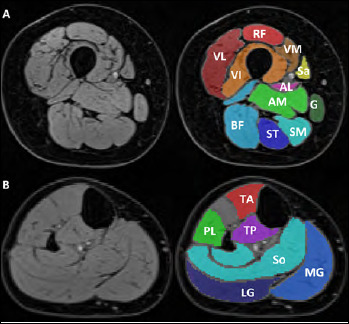 Muscle quantitative MRI in adult SMA patients on nusinersen treatment: a longitudinal study.