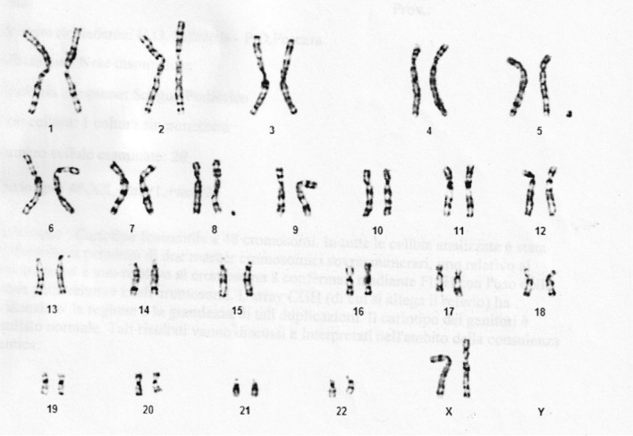 First case of two supernumerary markers derived from chromosome 5 and chromosome 8.