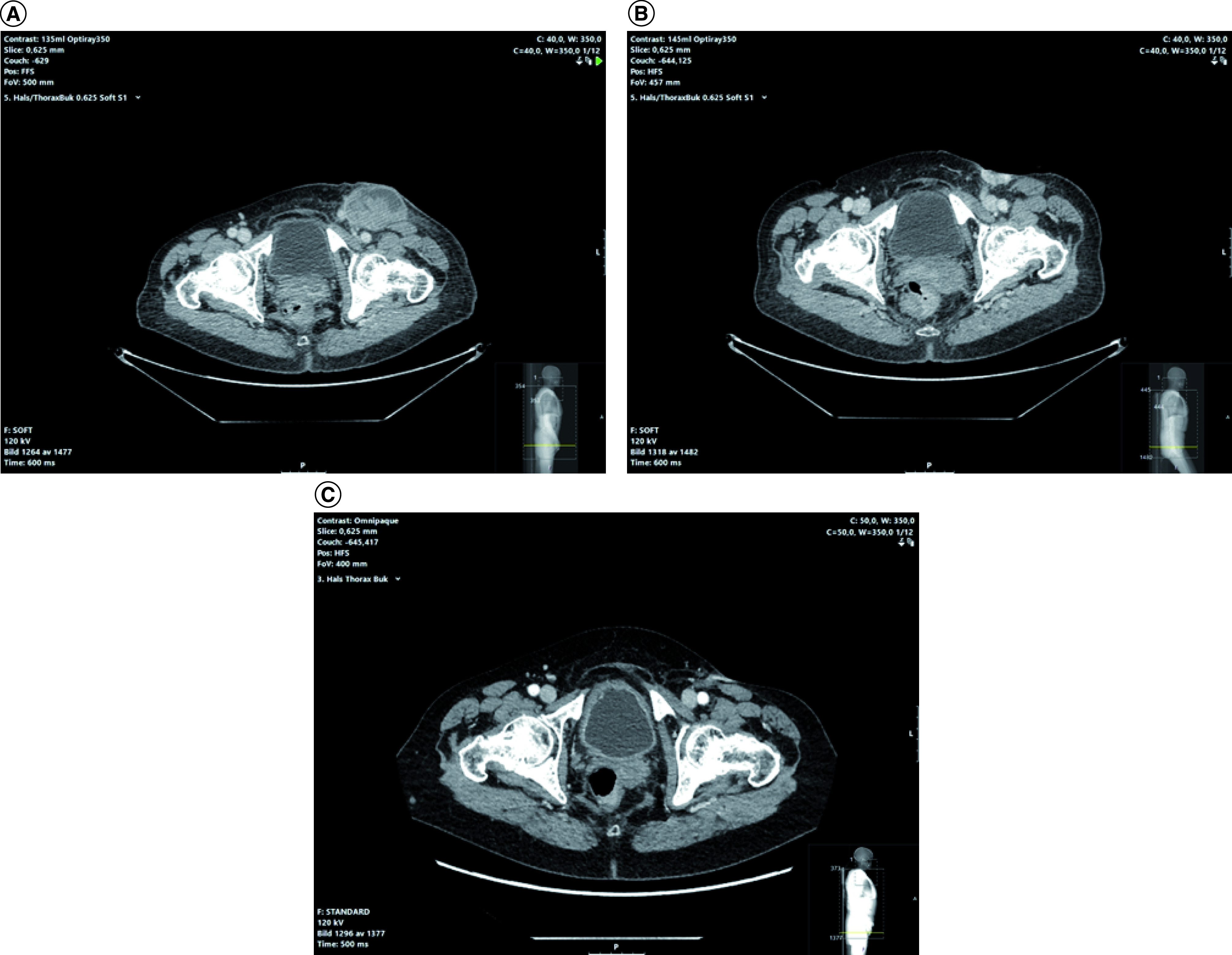 Successful electrochemotherapy treatment of a large bleeding lymph node melanoma metastasis.